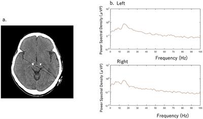 Case Report: Chronic Adaptive Deep Brain Stimulation Personalizing Therapy Based on Parkinsonian State
